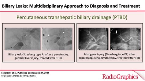 b4il3e leaks|Biliary Leaks: Multidisciplinary Approach to Diagnosis。